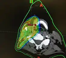 Diagram of radiation therapy contours used in treating a right tonsillar cancer