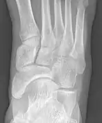 Cornuate navicular bone