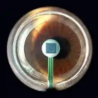 SensorTip of a PASCAL tonometer in contact with patient's cornea