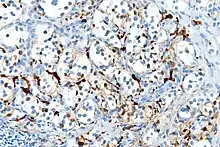 S100 immunostain highlighting the sustentacular cells in a paraganglioma