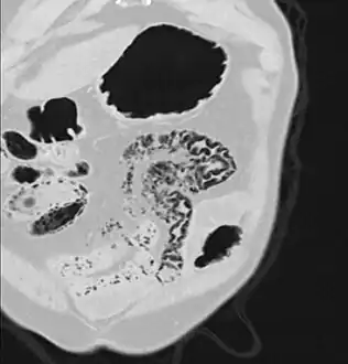 Coronal reformatted MDCT image showing extensive pneumatosis intestinalis in the left upper quadrant small bowel.  The pneumatosis is more cystic and nodular in the small bowel in the midline and the right of midline. This patient had a relatively benign presentation without bowel ischemia and was treated conservatively.