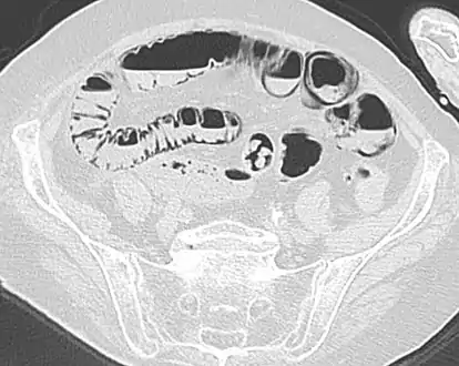 Pneumatosis intestinalis in computed tomography with intestinal ischemia. Lung window for better representation of the gas deposits in the intestinal walls.