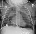 Pneumomediastinum with angel wing sign