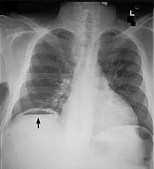 Free air under diaphragm seen on abdominal X-ray.
