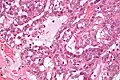 Micrograph of a polymorphous low-grade adenocarcinoma. H&E stain.