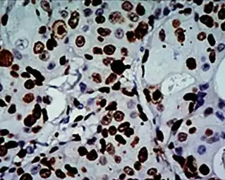 High Ki-67 expression in an invasive breast cancer, with cancer nuclei being stained (brown). There is tumor cell positivity in 70% of the cells:Ki-67 labelling index = 70%
