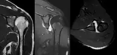 MRI of the shoulder after an anterior dislocation showing a Hill-Sachs lesion and labral Bankart lesion