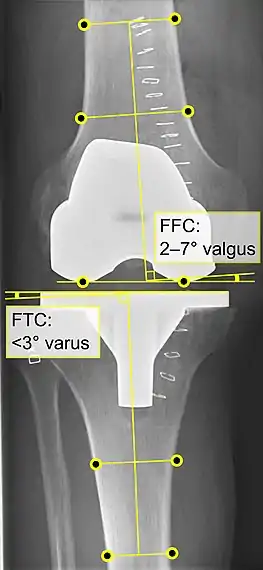 - FFC: frontal femoral component angle. It is typically regarded as optimal when being 2–7° in valgus.- FTC: frontal tibial component angle, which is regarded as optimal when being at a right angle. A varus position of more than 3° has generally been found to increase the failure rate of the prosthesis.