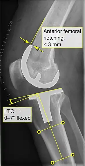 - Anterior femoral notching (the femoral component causing reduced thickness of the distal femur anteriorly), seems to cause an increased risk of fractures when exceeding about 3 mm.- LTC: lateral (or sagittal) tibial component angle, which is ideally positioned so that the tibia is 0–7° flexed compared to at a right angle with the tibial plate.