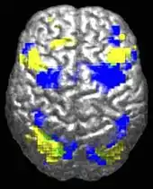 A human brain viewed from above. About 10% is highlighted in yellow and 10% in blue. There is only a tiny (perhaps 0.5%) green region where they overlap.