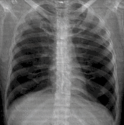 Projectionally rendered CT scan, showing the transition of thoracic structures between the anteroposterior and lateral view