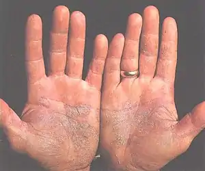 Psoriasis on a pair of hands. The disease can be caused by faulty JAK-STAT signalling.