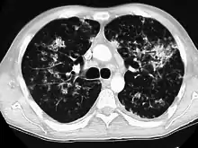 CT image showing centrilobular pattern of GGOs in patient with pulmonary tuberculosis. Note the small, nodular areas of increased attenuation in both lungs.