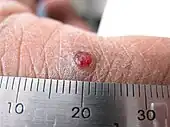 A solitary papule of inflamed vascular granulation tissue on the index finger of an adult