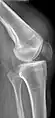 Quadriceps tendon rupture in plain X-ray