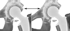 Acetabular inclination is normally between 30 and 50°. A larger angle increases the risk of dislocation.
