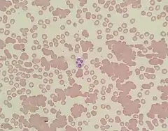 A photomicrograph of a blood smear showing red blood cells in clumps