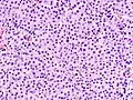 Micrograph of a renal oncocytoma. H&E stain.