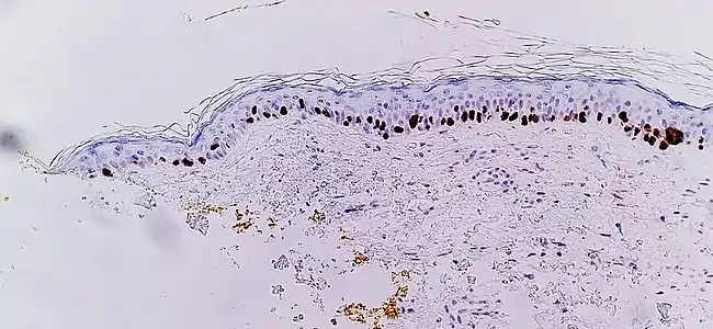 Immunohistochemistry with SOX10 (staining the cell nuclei of melanocytes) facilitates diagnosis of lentigo maligna, in this case showing an increased number of melanocytes along stratum basale of the skin, and nuclear pleomorphism. The changes are continuous with the resection margin (inked in yellow, at left), conferring a diagnosis of a not radically removed lentigo maligna.