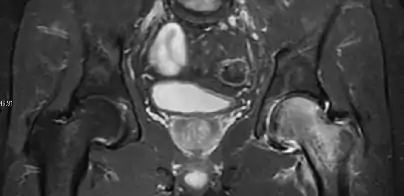 Coronal stir imaging in transient osteoporosis, showing diffuse edema.