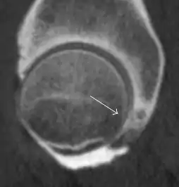 Sagittal CT-arthrography showing posteroinferior chondral injury.