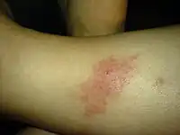 Sandfly bite
