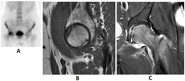 Scintigraphy (A), sagittal T1 (B), and coronal PD fat sat of a patient with a subchondral fracture of the femoral head with convex shape to the articular surface.