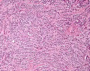 Low magnification micrograph of a Sertoli cell tumour. H&E stain.