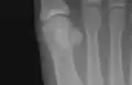 Sesamoid bones at the distal end of the first metatarsal.