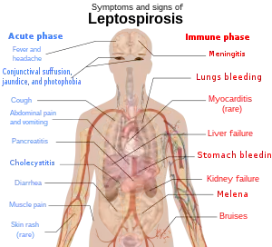 A schematic of the human body showing the symptoms and signs of leptospirosis