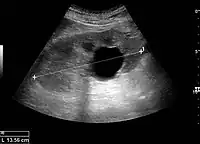 Figure 5. Simple renal cyst with posterior enhancement in an adult kidney. Measurement of kidney length on the US image is illustrated by '+' and a dashed line.