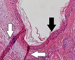 Folding artifacts (white arrows) and a crush artifact (black arrow, with cytoplasmic hypereosinophilia and nuclear pleomorphism) from a needle.