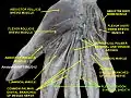 flexor tendon sinovial sheath of hand