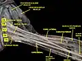 Brachial plexus. Deep dissection. Anterolateral view