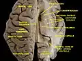 Ventricles of brain and basal ganglia. Superior view, horizontal section, deep dissection