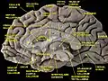 Medial surface of cerebral hemisphere.Medial view.Deep dissection.