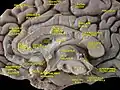 Cerebrum. Medial face. Dissection of corpus callosum etc.