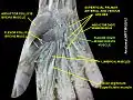 Flexor digiti minimi brevis muscle