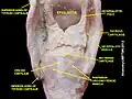 Aryepiglotic muscle