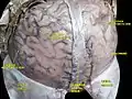 Meninges and superficial cerebral veins.Deep dissection.Superior view.