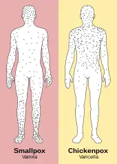 In contrast to the rash in smallpox, the rash in chickenpox occurs mostly on the torso, spreading less to the limbs.