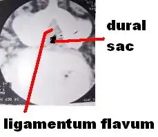 CT scan of spinal stenosis and thickened ligamentum flavum, causing neurogenic claudication