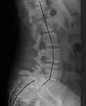 X-ray of a grade 4 anterolisthesis at L5-S1 with spinal misalignment indicated
