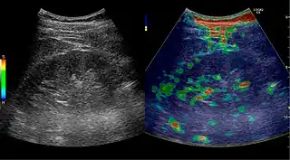 Figure 32. Strain elastography of a normal kidney. Red depicts soft areas, and blue depicts hard areas relative to the entire elastography image. Note that the medulla is softer than the cortex. A color bar is shown to the left of the image, where "S" and "H" denote soft and hard tissue, respectively.