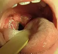 A set of large tonsils in the back of the throat, covered in white exudate.This is a culture-positive case of streptococcal pharyngitis with typical tonsillar exudate in an 8-year-old.