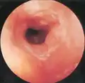 Grade 1 subglottic stenosis