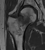 T1-weighted, turbo spin echo, MRI confirms a fracture, as the surrounding bone marrow has low signal from edema.