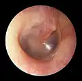 A normal human right tympanic membrane (eardrum)