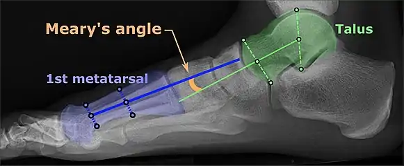 Same lateral X-ray showing the measurement of Meary's angle, which is the angle between the long axis of the talus and first metatarsal bone. This example is slightly convex downward. An angle greater than 4° convex upward is considered pes cavus.
