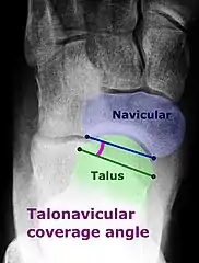 Dorsoplantar projectional radiograph of the foot showing the measurement of the  talonavicular coverage angle.